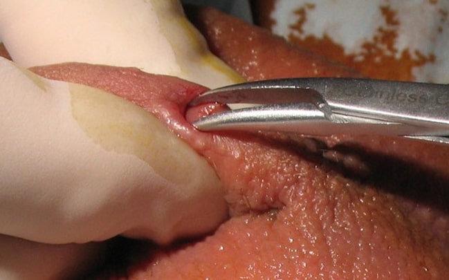 No-Scalpel Vasectomy
