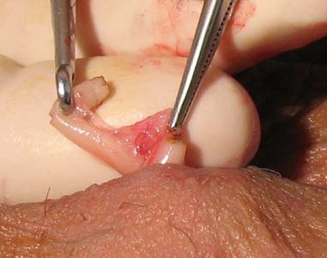 Divide and Interpose Fascia